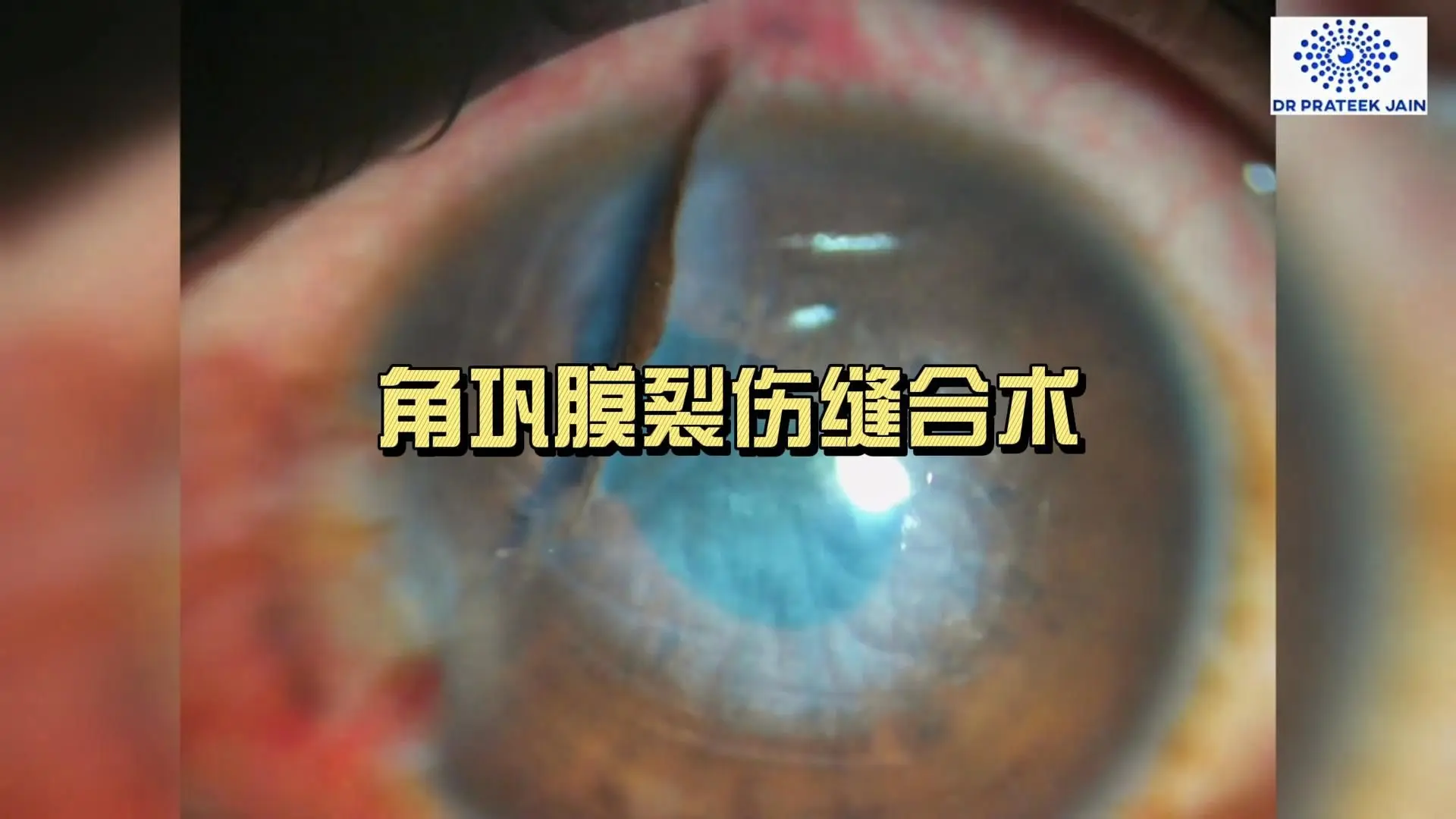 角巩膜裂伤缝合术_哔哩哔哩_bilibili