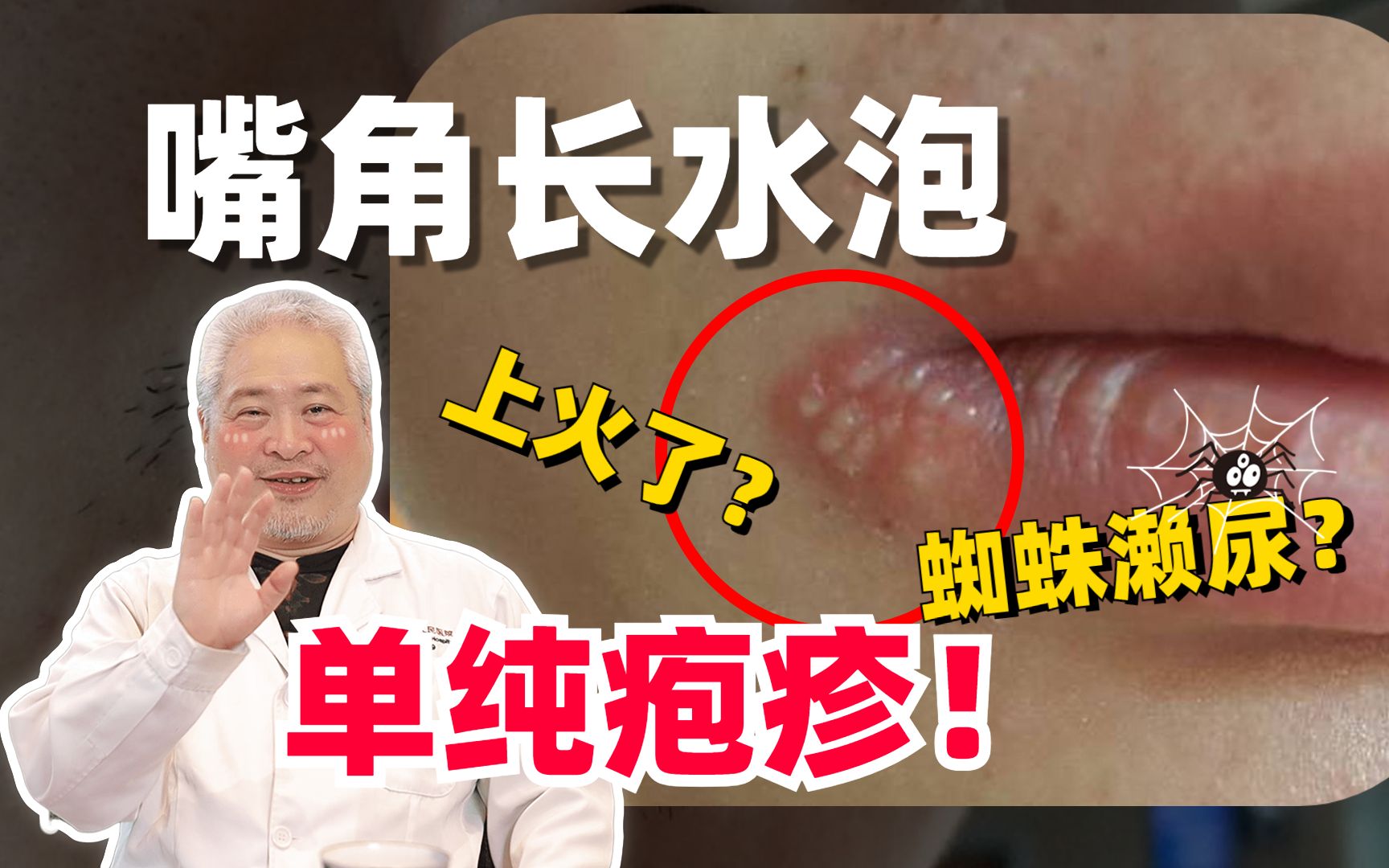 【科普】嘴上长泡,蜘蛛濑尿?老一辈的传言,你还听过什么~-皮肤科教授孙广政-皮肤科教授孙广政-哔哩哔哩视频