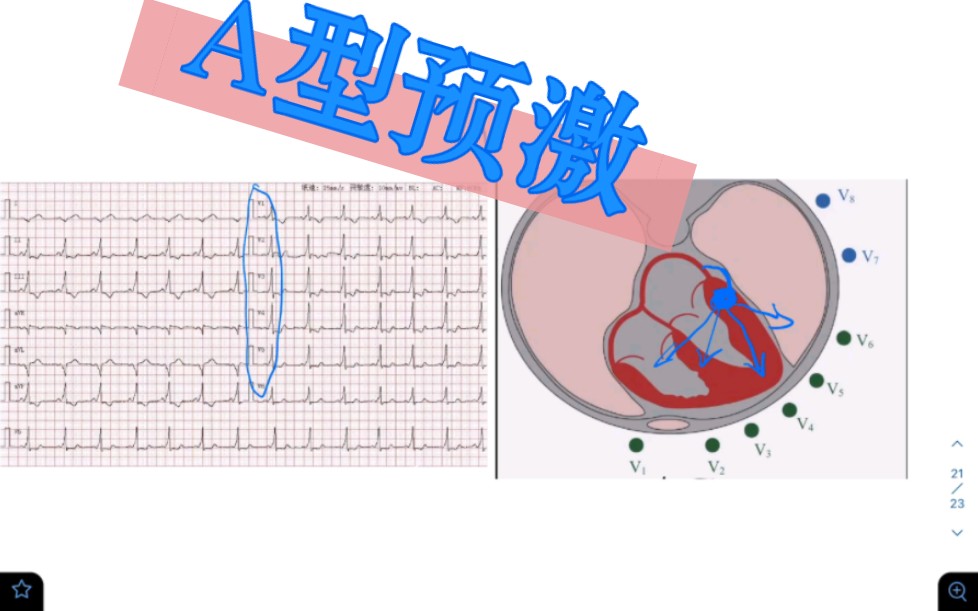 窦性心律,A型预激旁路,继发STT改变哔哩哔哩bilibili