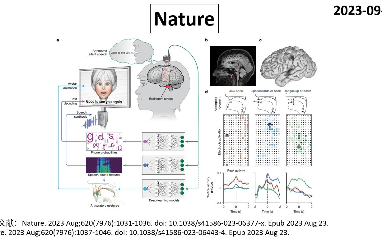 Nature—渐冻症和脑卒中患者有福了,语言脑机接口可部分恢复语言功能哔哩哔哩bilibili