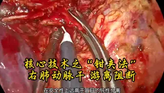 核心技术之“钳夹法”右肺动脉干 游离阻断（单孔胸腔镜）何丹教授供稿