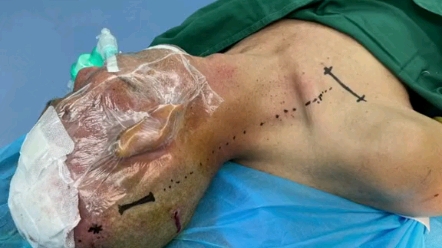 安装了脑起搏器,电池在胸前,电极在头部.两者是怎么连结的你知道吗?