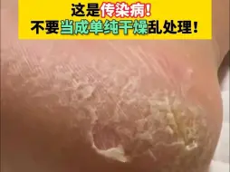 下载视频: 以为只是死皮？别扣了！这是真菌感染