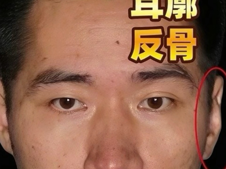 耳廓反骨,人中赤红,打交道容易不讲信用