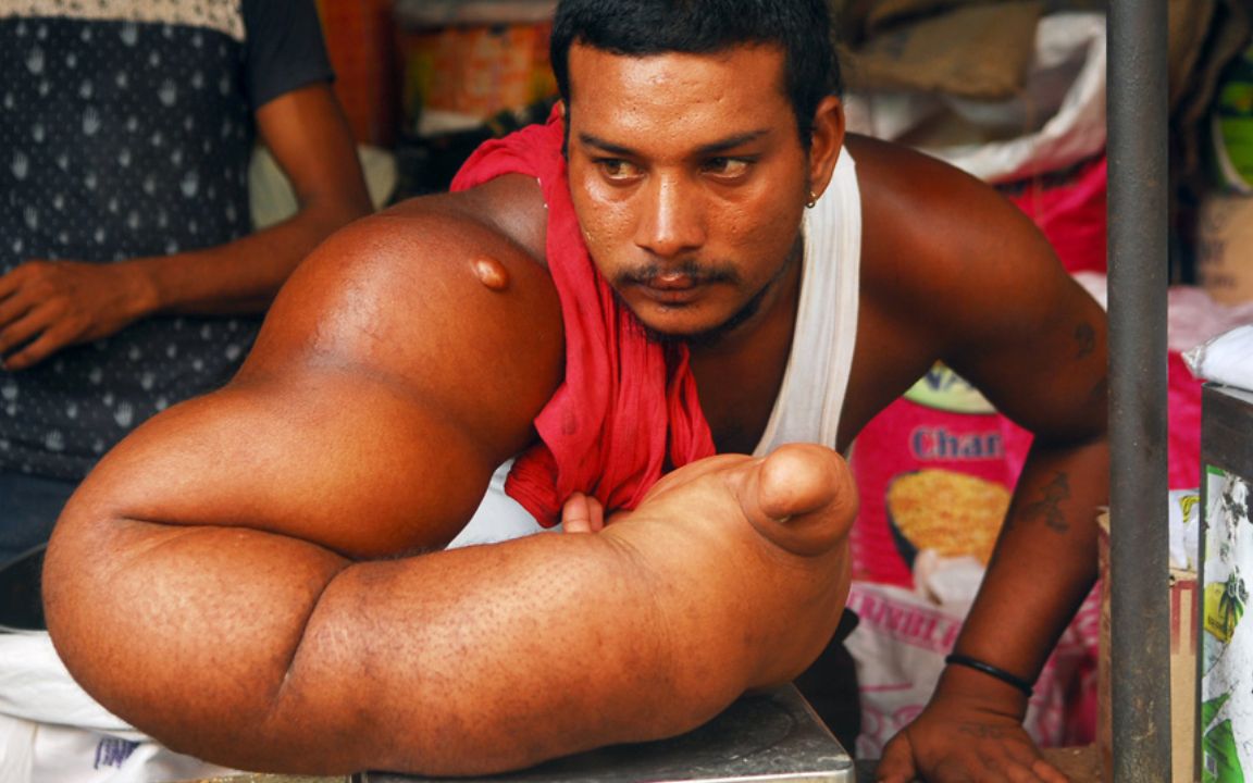 印度男子患罕见疾病,右臂重达20公斤,被称为魔鬼之子,赶出家乡