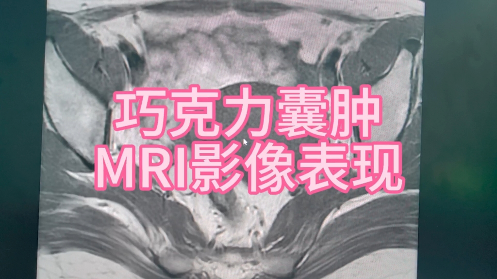 巧克力囊肿的MRI影像表现,一起来看看吧!哔哩哔哩bilibili