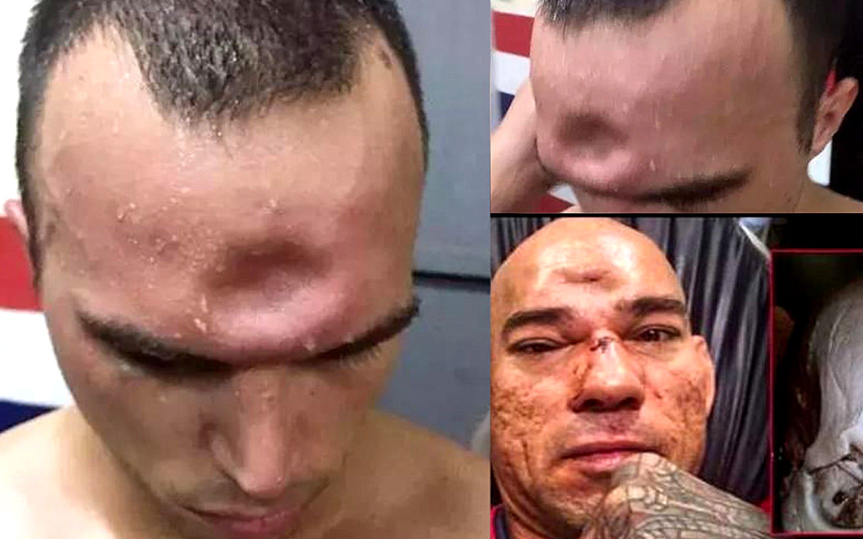 肘击的威力有可怕?这位泰拳手被一肘击碎头骨,脑门都凹进去了