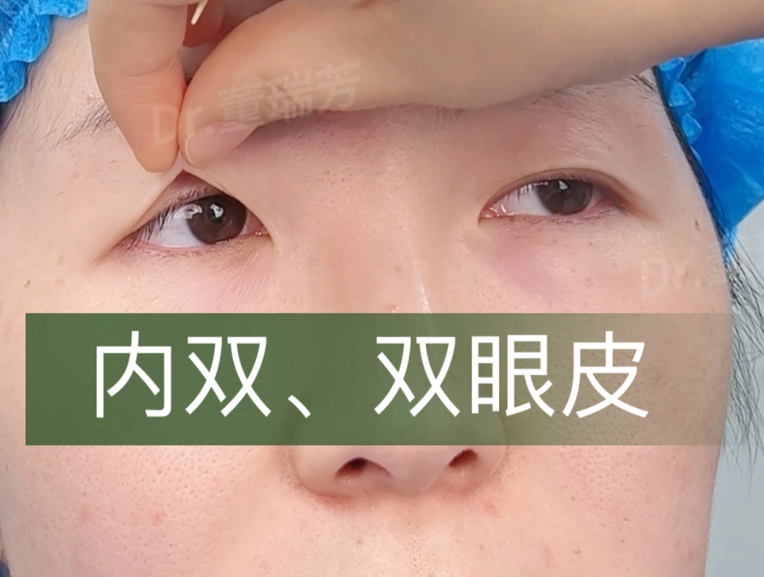 内双变成双眼皮,需要去掉多少皮
