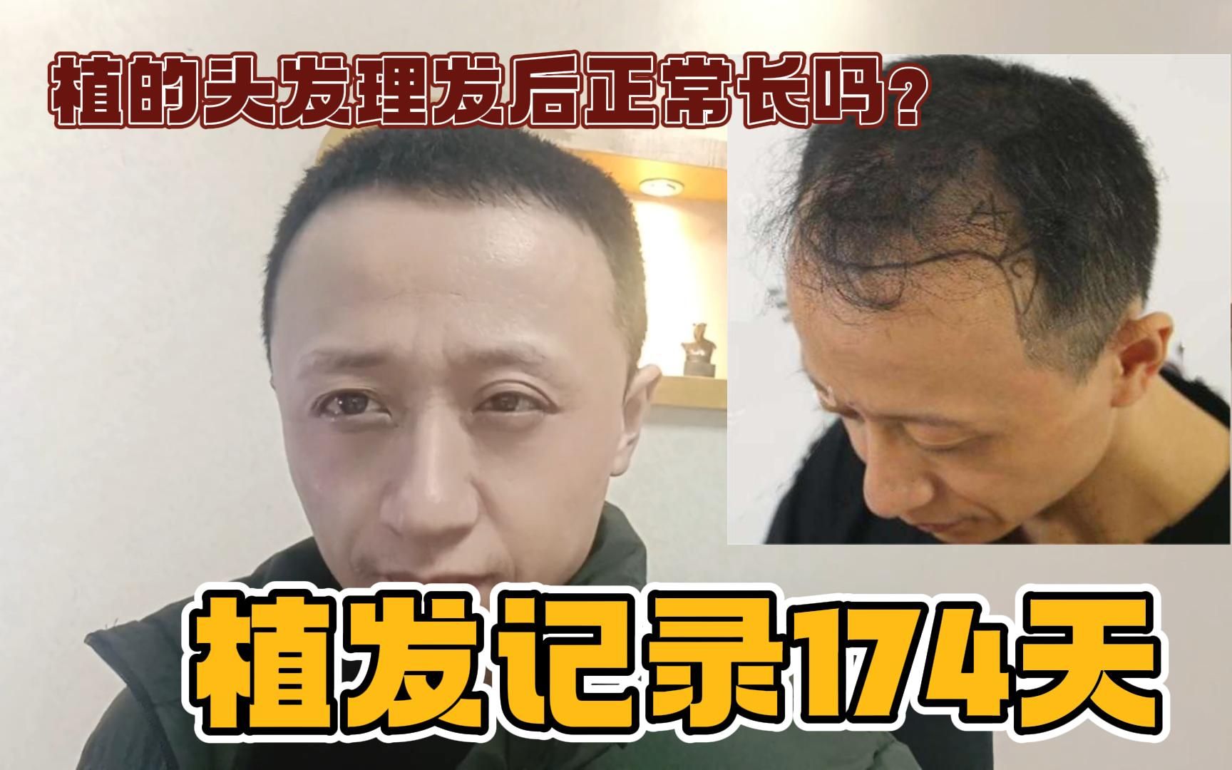 前额大面积植发174天,这2w花得怎么样?植的头发理发后正常长吗?哔哩哔哩bilibili