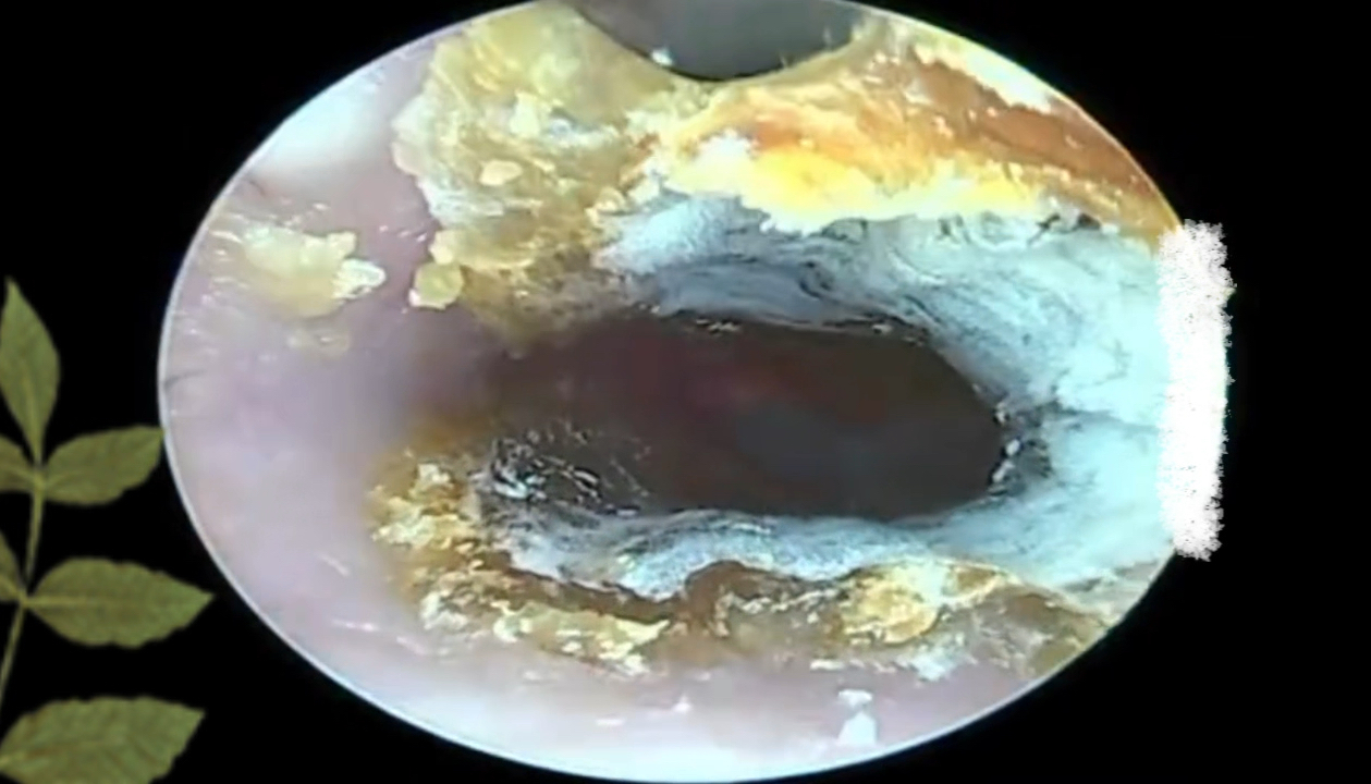 耳道霉菌干片;把这一大块完整的拔出来