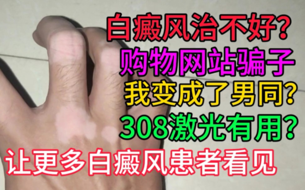 UP患白癜风8年!亲身经历告诫B站网友!白癜风如何医治不吃亏哔哩哔哩bilibili