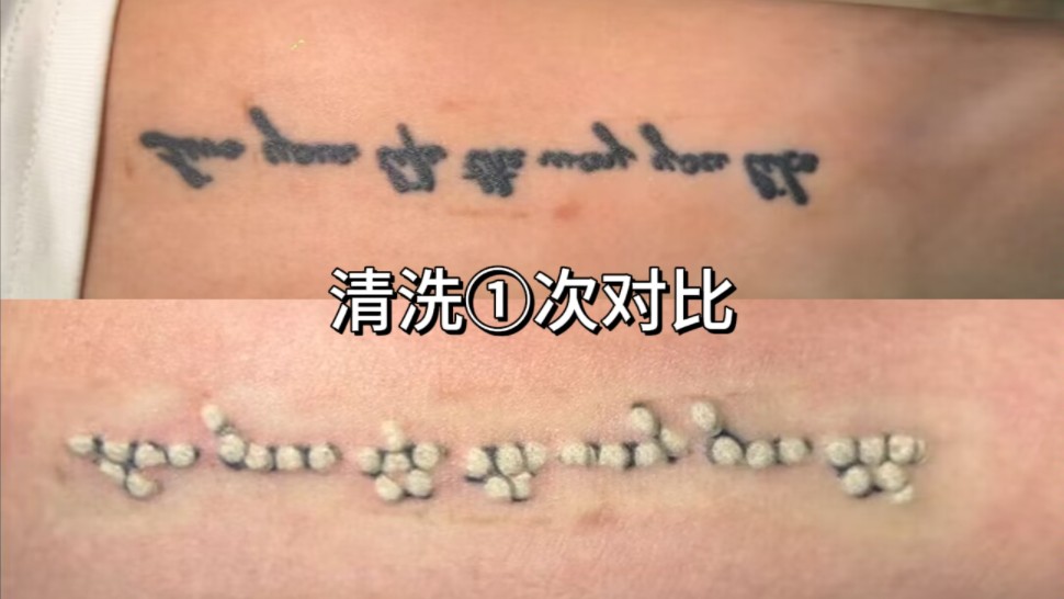记录第一次清洗纹身