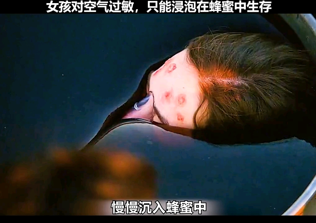 蜂蜜和什么过敏症状一样呢(蜂蜜和什么一起吃容易过敏)