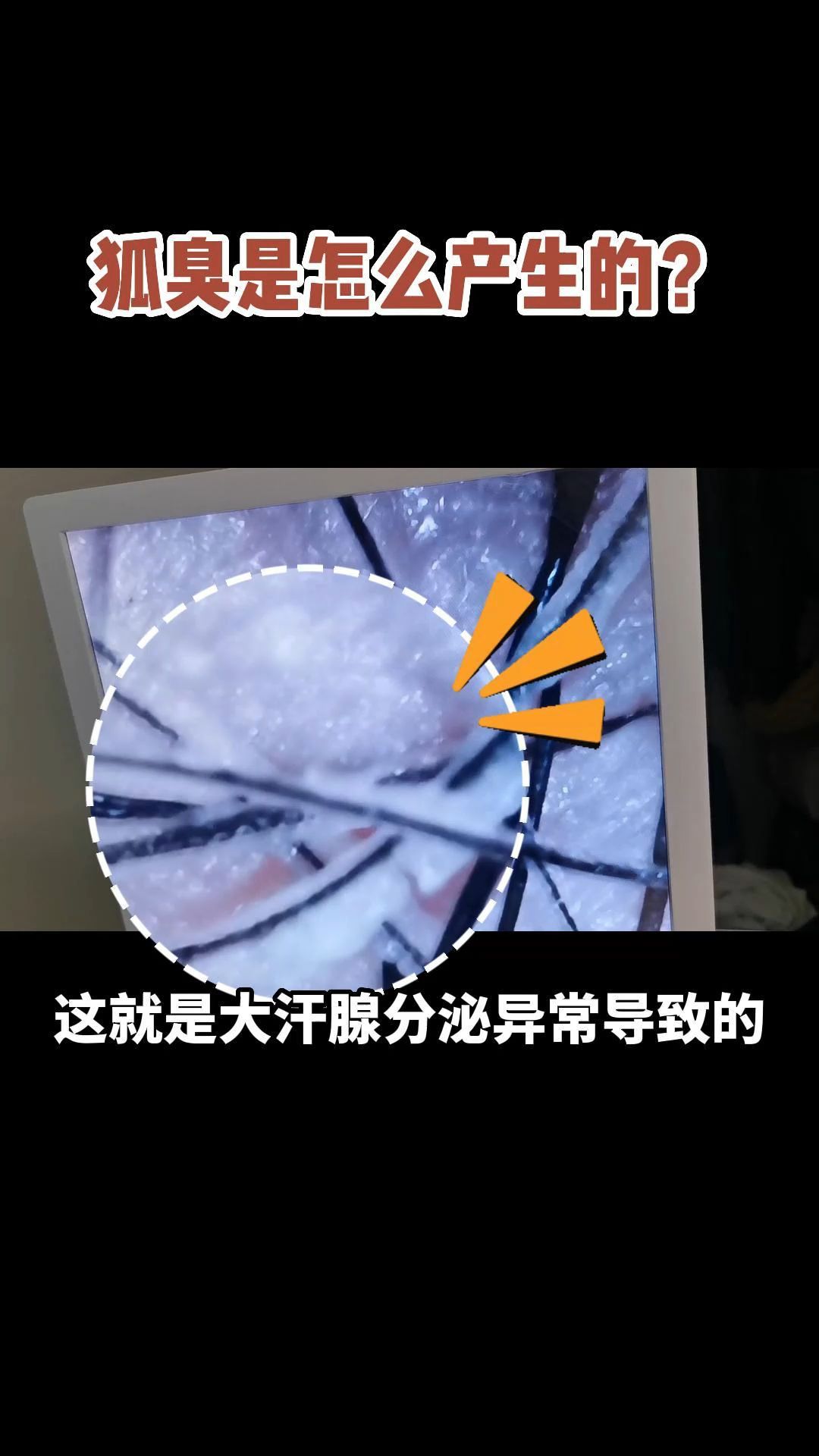 狐臭是怎样产生的哔哩哔哩bilibili