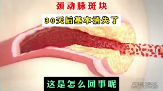 Download Video: 颈动脉斑块 30天基本消失了，这是怎么做到的