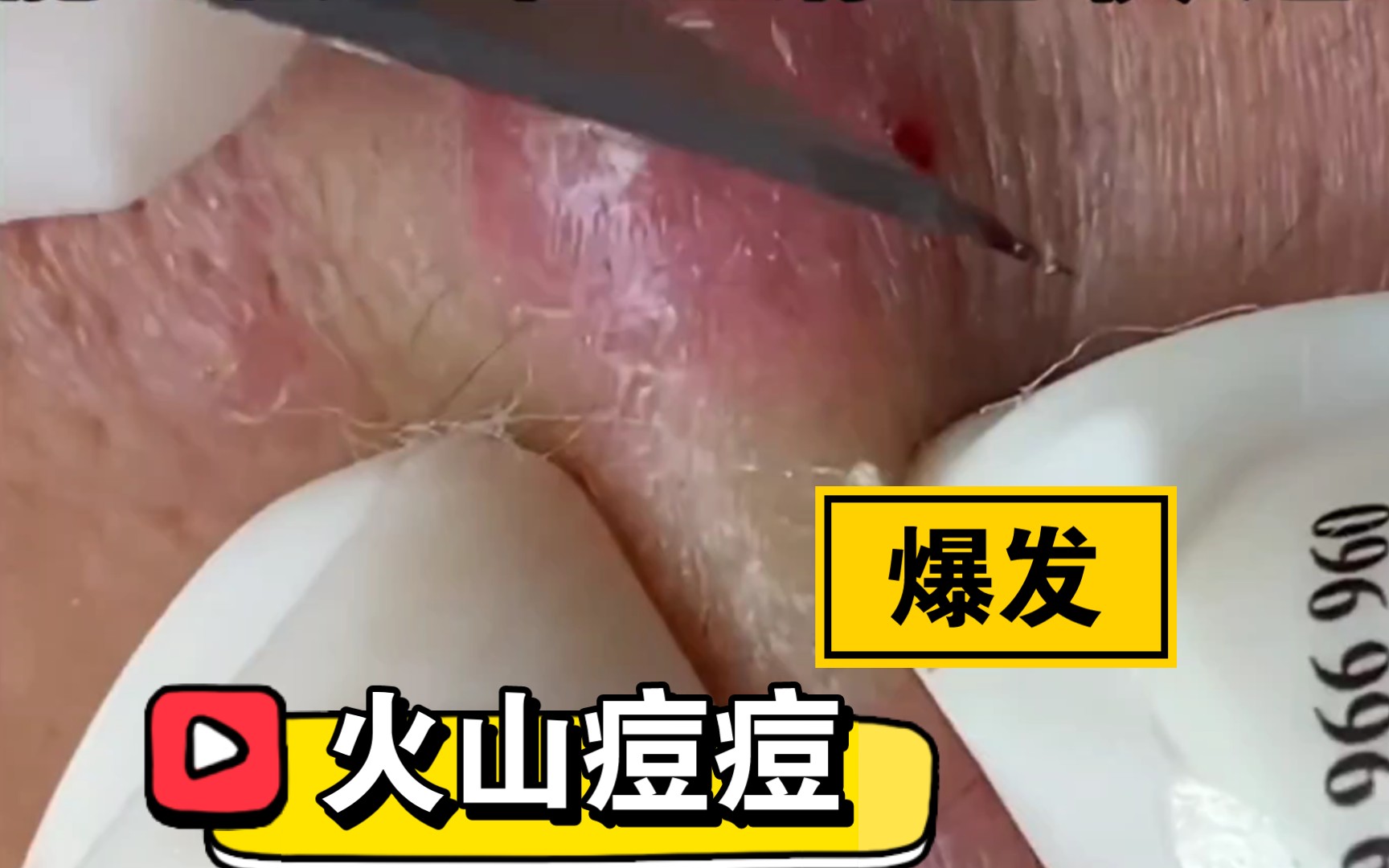 【解压助眠】针清|面部护理|深层清洁|黑头粉刺|毛孔粗大|果粒橙|沉浸