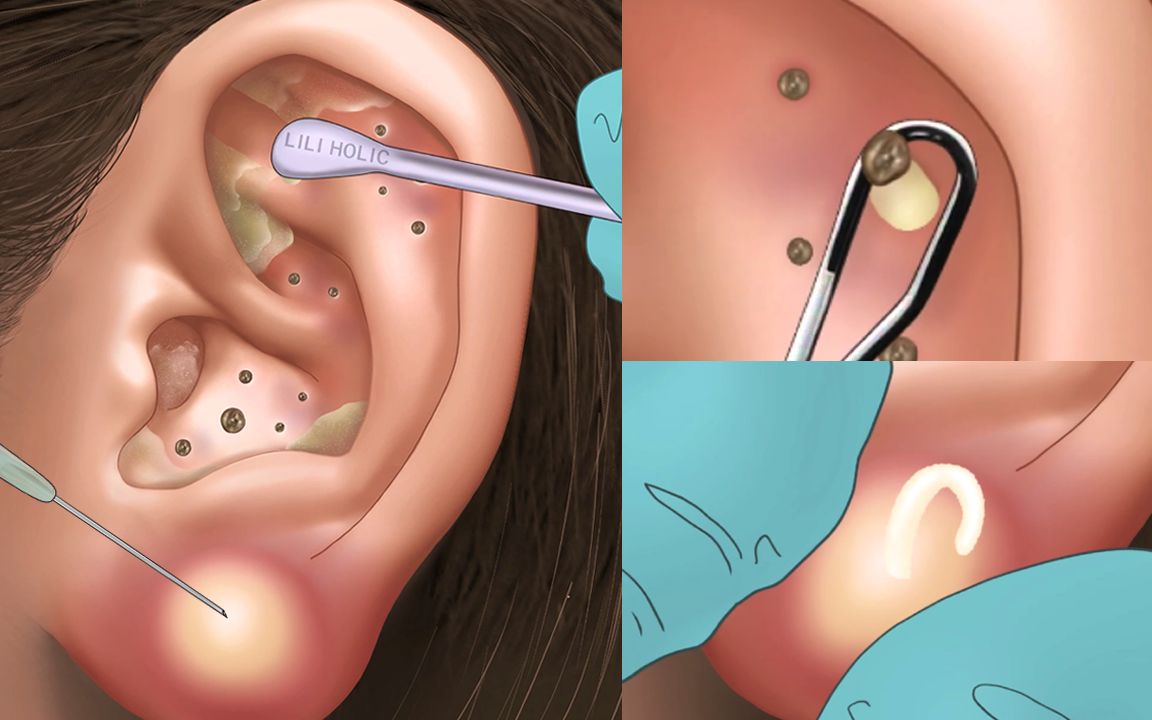 [图]令人极度舒适的耳部清洁过程，去除囊肿 | 定格动画 | 解压动画