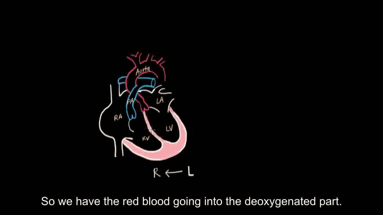 搬运khanacademy循环系统疾病einsenmengercoarctationof02aorta