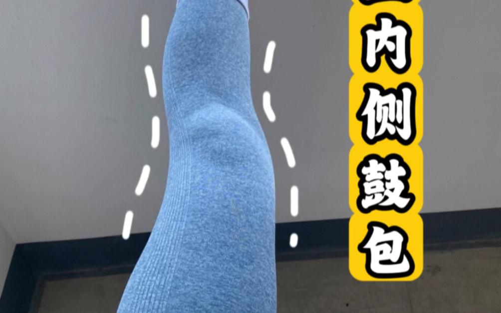 膝盖内侧鼓包纠正跟练