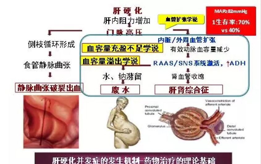 肝脏疾病重难点系列(三)肝硬化相关腹水鉴别:SBP门静脉血栓肝肾综合征肝癌继发性腹膜炎结核性腹膜炎哔哩哔哩bilibili