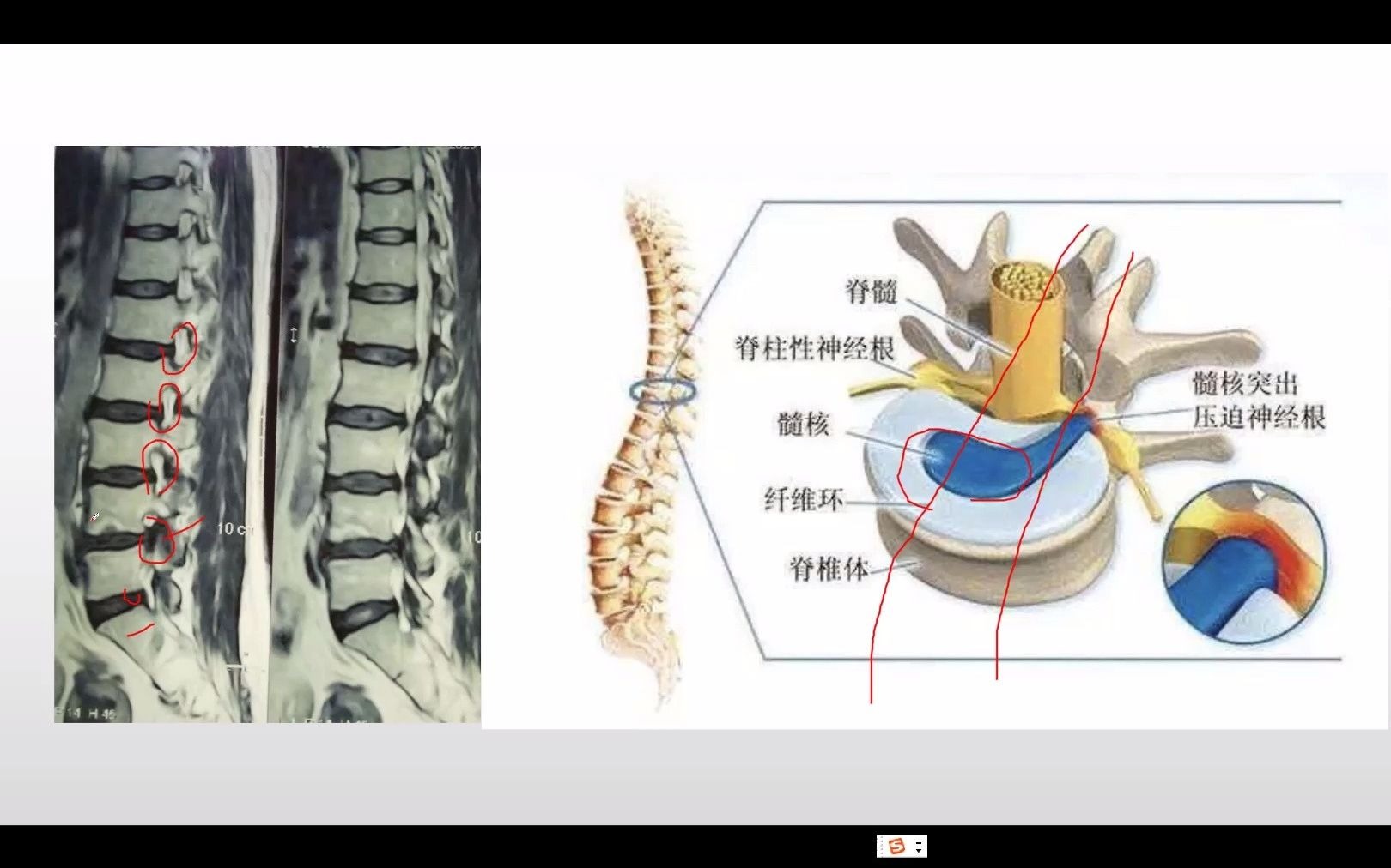 横突孔和椎间孔解剖图图片