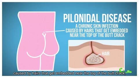 Scishow 屁股上为何会长毛 英语字幕 哔哩哔哩 Bilibili