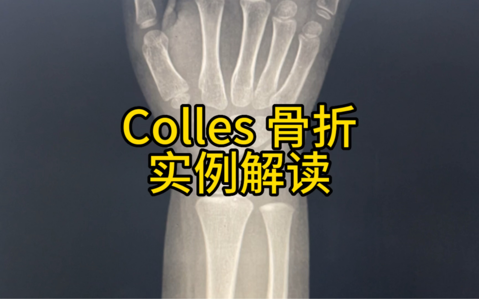 Colles 骨折实例解读哔哩哔哩bilibili