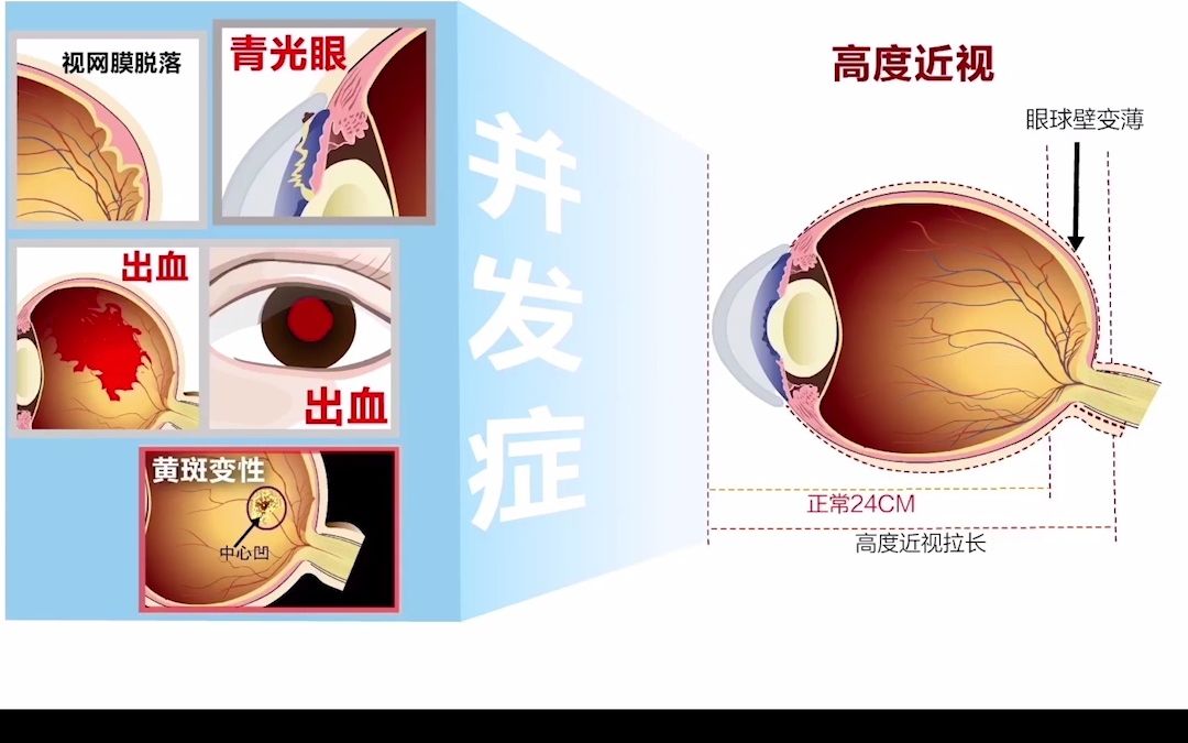 愛爾眼科15五種會致盲的危險眼病