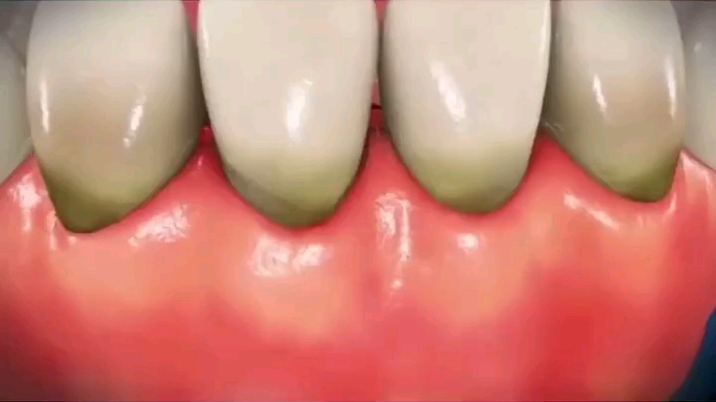 来看牙周翻瓣术 如何消除牙周袋