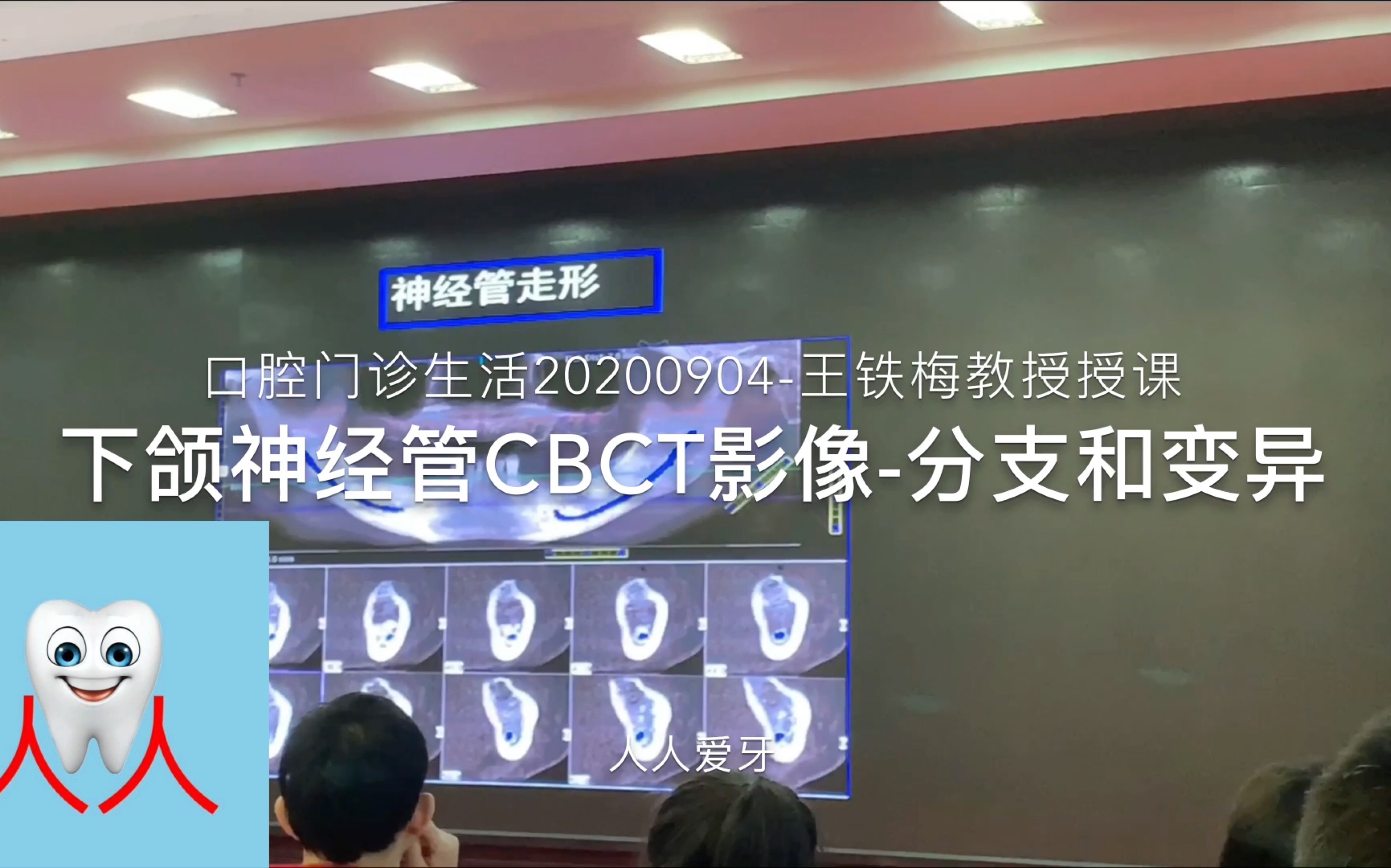 下颌神经管CBCT影像分支和变异口腔门诊生活20200904哔哩哔哩bilibili