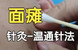 Video herunterladen: 面瘫，口角歪斜， 针灸治疗效果显著