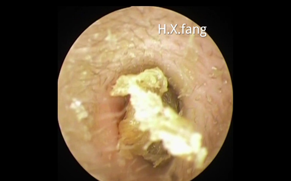 专业可视采耳-耳垢和死皮清除ear wax removal-dead skin cleaning