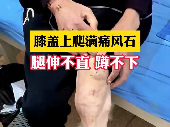 膝盖上爬满痛风石,腿伸不直,蹲不下