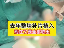 男子去年整块补片植入，现在又要全部取出