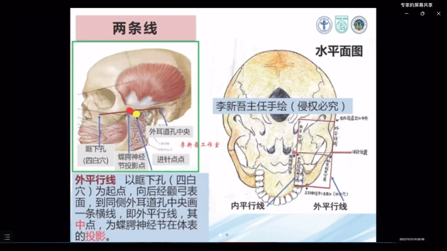 针刺蝶腭神经节的操作哔哩哔哩bilibili