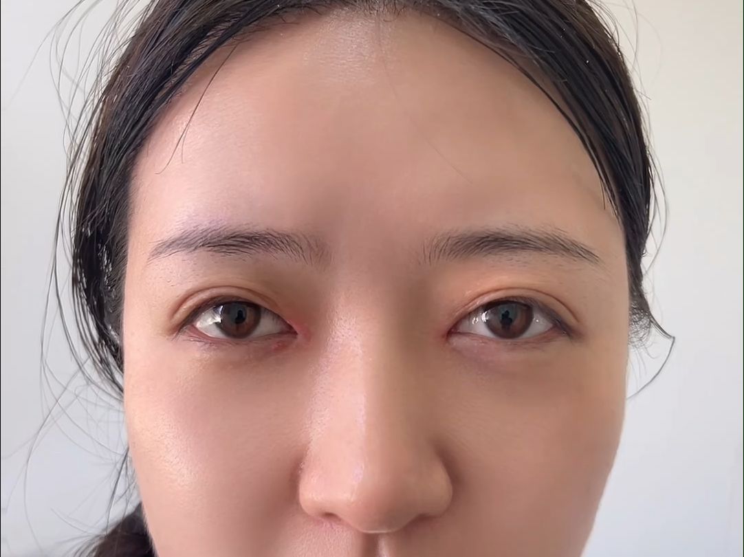 内眼角修复术后11天