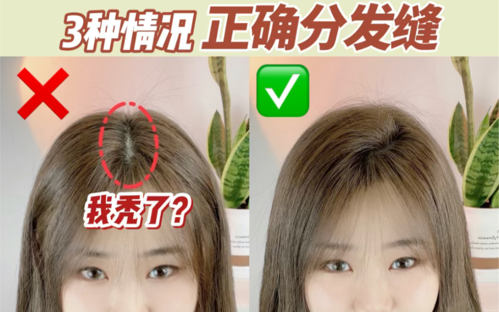 3种情况正确分发缝7414改善宽发缝7414告别假秃变真秃_哔哩