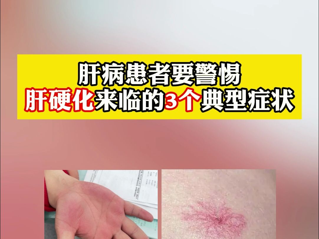 肝病患者要警惕