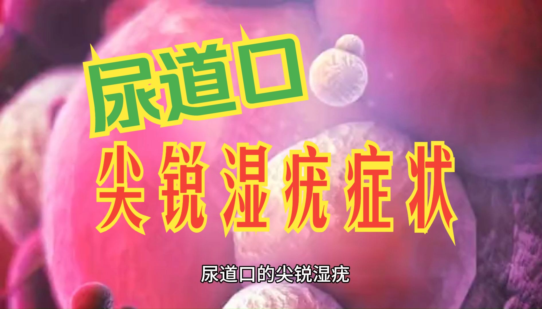 【尖锐湿疣科普】尿道口尖锐湿疣症状
