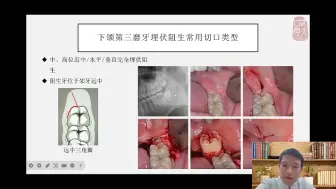 Tải video: 阻生牙拔除术的切口设计与选择——周小程（武大口腔）