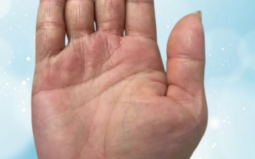 手指跟打了蜡一样,有点不自然.不过指节间米糠纹还是很明显