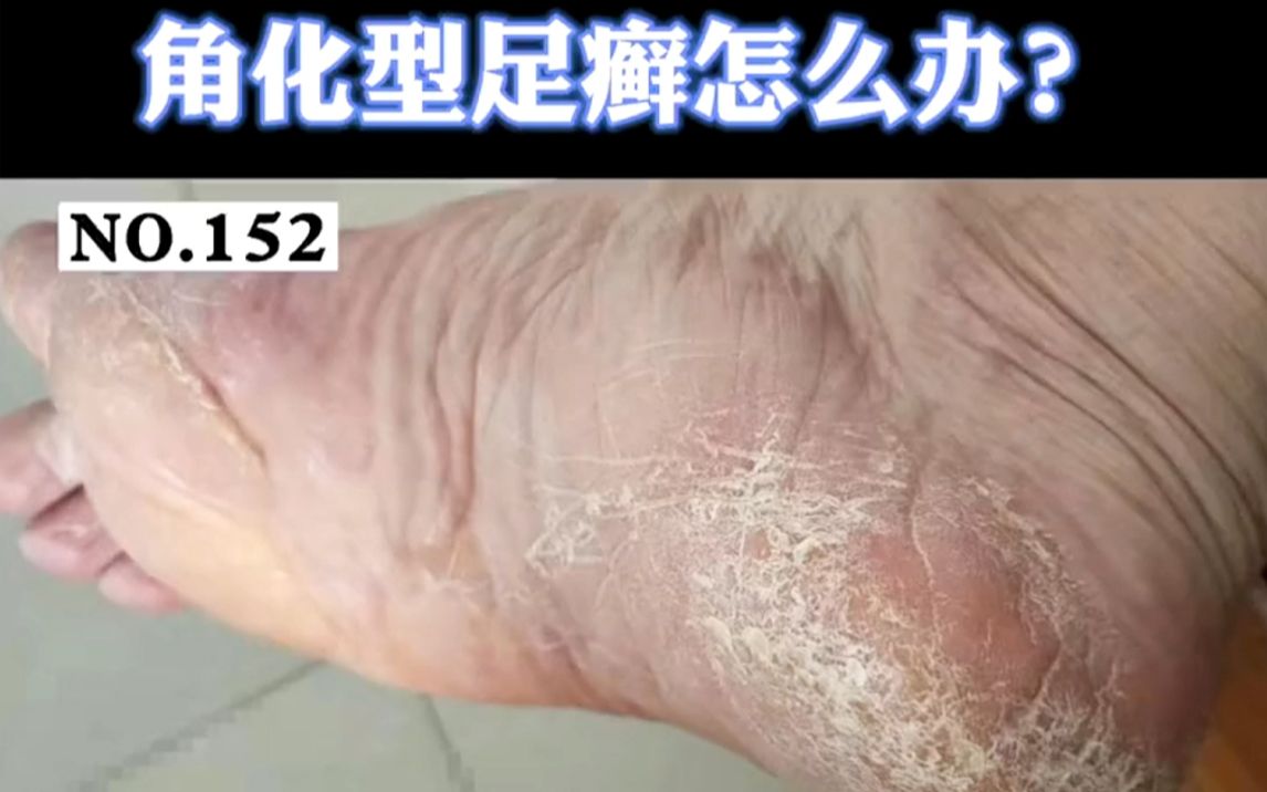 小病不治化大病!脚后跟皮肤增厚开裂是真菌感染!