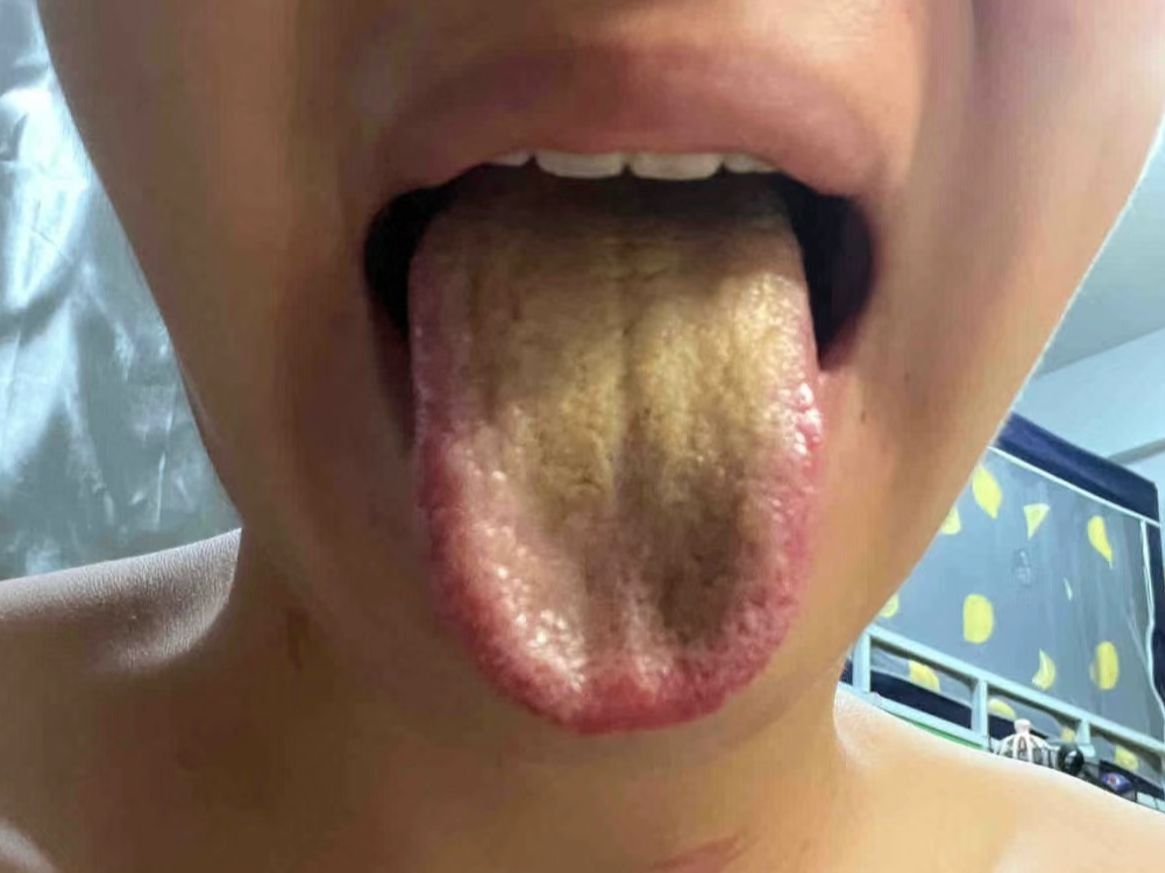 舌苔黄腻不像话,清湿除热大错特错,只会湿上加湿,热上加热!