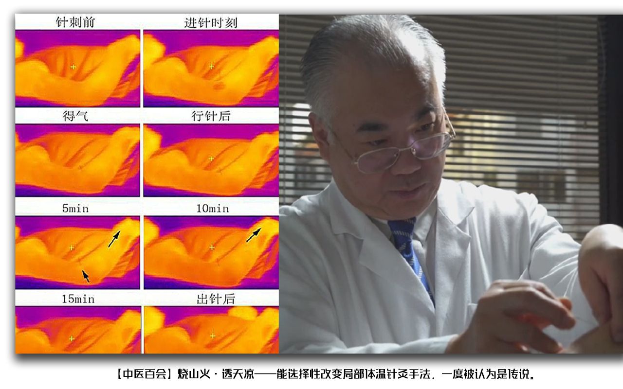 [图]烧山火·透天凉——能选择性改变局部体温针灸手法，一度被认为是传说。