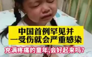 中国首例罕见病PAPA综合征,大夫说,这种病需要终身接受治疗,馨馨加油!哔哩哔哩bilibili