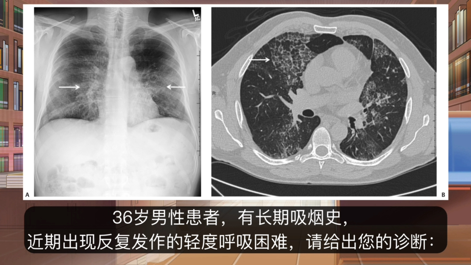 吸烟有害身体健康——两肺斑片状磨玻璃密度影,呈地图样分布的肺泡