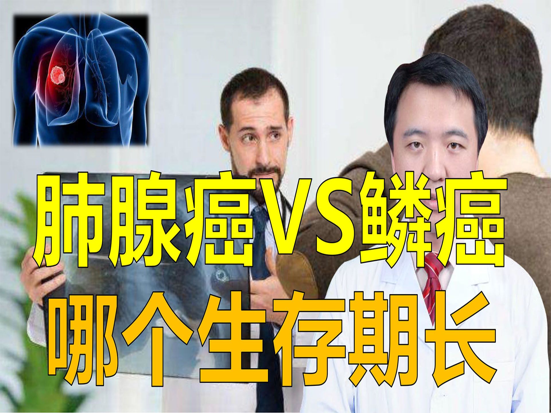 肺腺癌和鳞癌,哪个生存时间长?专家告诉你哔哩哔哩bilibili