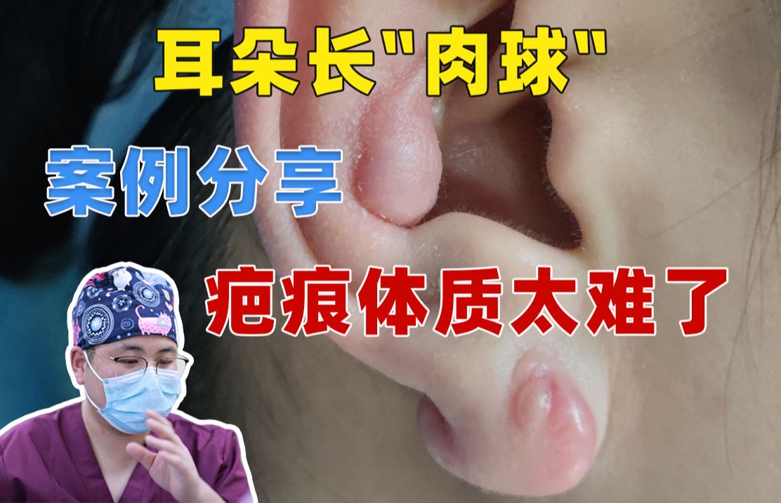 【案例】耳朵上长了两年的肉疙瘩,终于可以“摘”掉了!哔哩哔哩bilibili