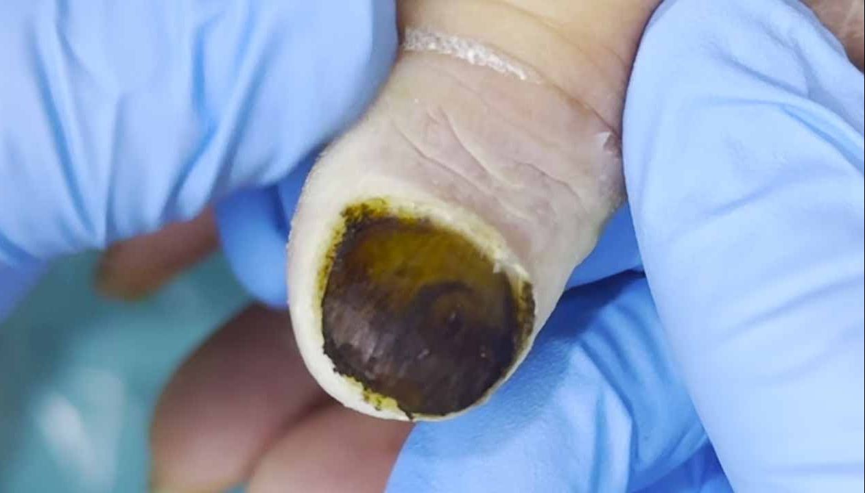 严重的甲真菌感染!已经开始化脓了!