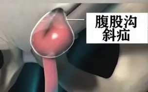 Download Video: 如果宝宝下腹部鼓起了一个小包，父母千万不要大意，可能是肠子漏出来了，这就是腹股沟斜疝